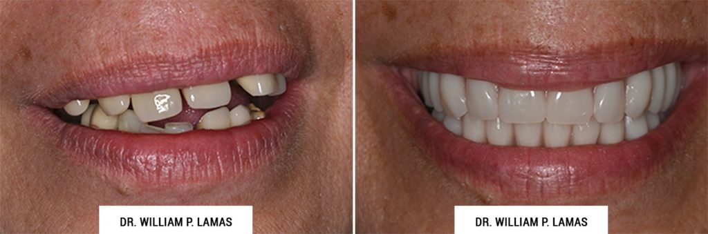 All-on-4 Dental Implants Before & After Photo - William P. Lamas, DMD - Periodontics & Dental Implants. Address: 2645 SW 37th Ave Suite 304, Miami, FL 33133 Phone: (305) 440-4114