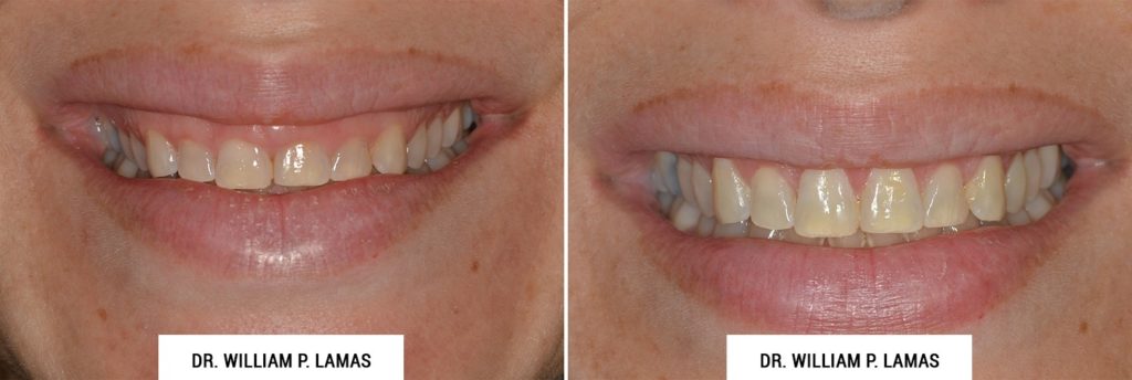 Crown Lengthening Before & After Photo - William P. Lamas, DMD - Periodontics & Dental Implants. Address: 2645 SW 37th Ave Suite 304, Miami, FL 33133 Phone: (305) 440-4114