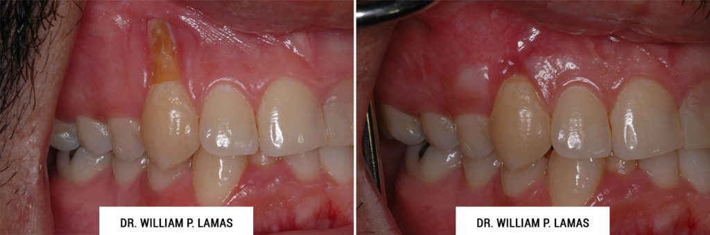 Gum Grafting Treatment Before & After Photo - William P. Lamas, DMD - Periodontics & Dental Implants. Address: 2645 SW 37th Ave Suite 304, Miami, FL 33133 Phone: (305) 440-4114