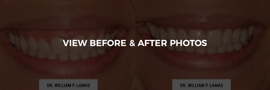 Crown Lengthening Before & After Photo - William P. Lamas, DMD - Periodontics & Dental Implants. Address: 2645 SW 37th Ave Suite 304, Miami, FL 33133 Phone: (305) 440-4114