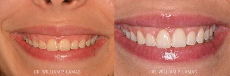 Gummy Smile Correction Before & After Photo - William P. Lamas, DMD - Periodontics & Dental Implants.