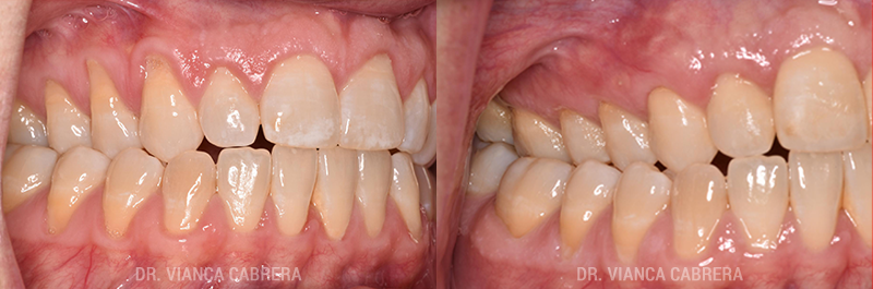 Gum Grafting Treatment Before & After Photo - Dr. Vianca Cabrera