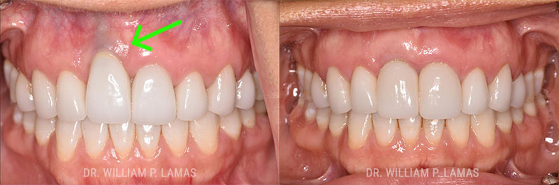 Periodontal Plastic Surgery Before & After Photo - William P. Lamas, DMD - Periodontics & Dental Implants.