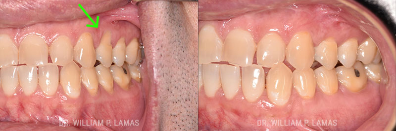 Gum Grafting Treatment Before & After Photo - William P. Lamas, DMD - Periodontics & Dental Implants