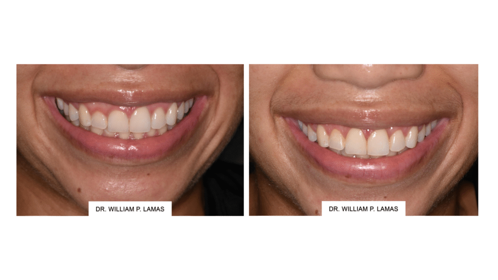smile correction by lamas dental